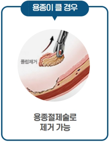 대장내시경-용종제거-선종제거-보험청구-방법안내
