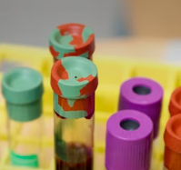 고지혈증 치료법 진단기준 예방