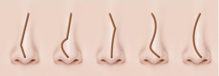 부비동염-원인-증상-치료-예방-방치하면-합병증으로