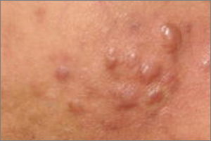 여드름 흉터 없애는법