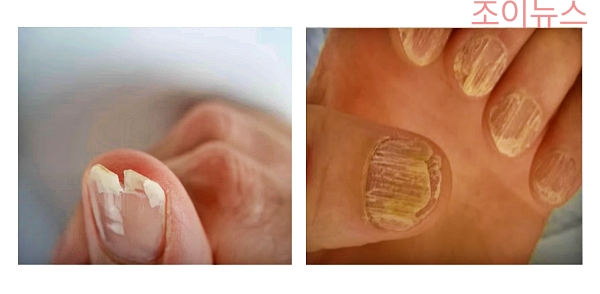 손톱이 부서지는 경우