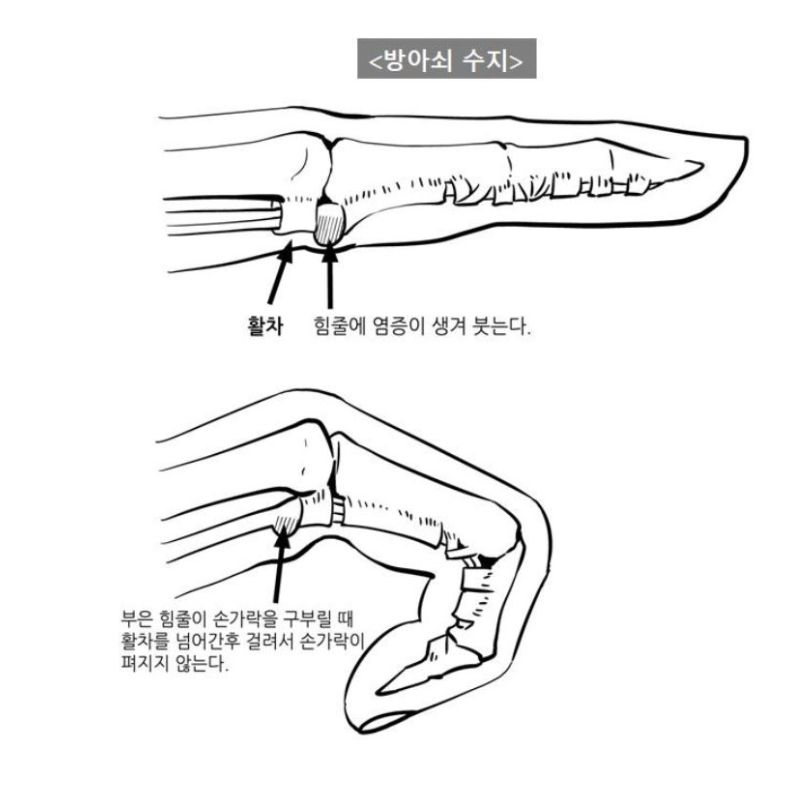 방아쇠수지증후군