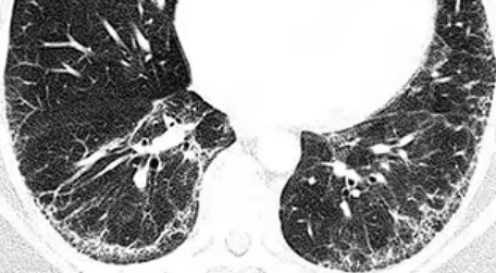 ILD lung CT 이미지