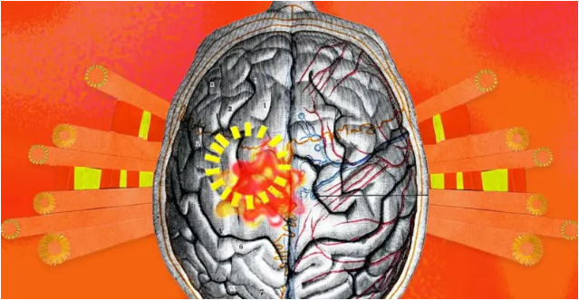 기후-변화-신경질환-환자-미치는-영향1