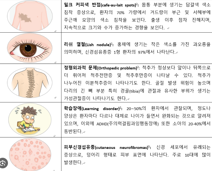 신경섬유종 밀크반점 원인 증상
