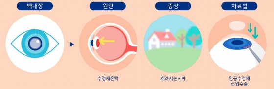 백내장의 원인과 수술방법