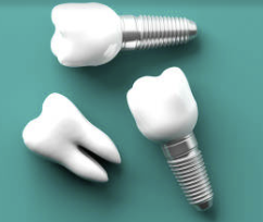 임플란트 시술기간