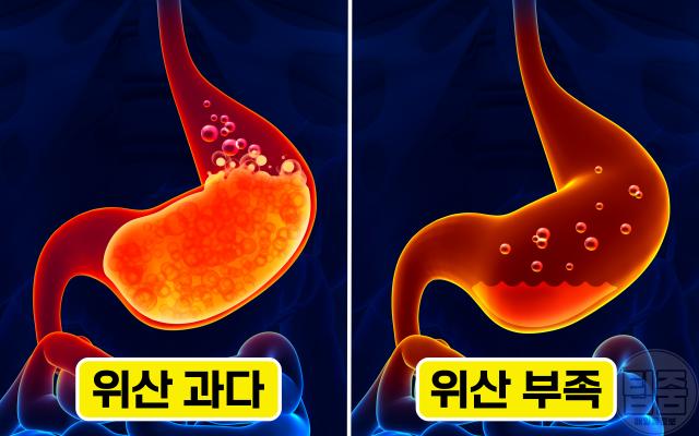 위산과다 위산부족 증상 구분
