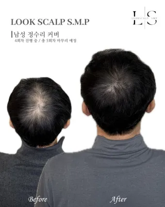 정수리가 아픈 이유와 완화하는 방법_20