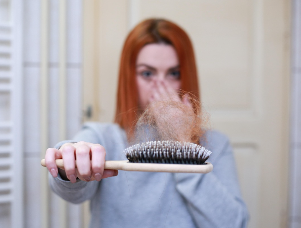 탈모 초기 증상으로 머리카락이 많이 빠진 여성