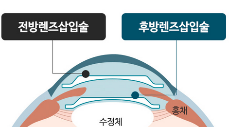 렌즈삽입