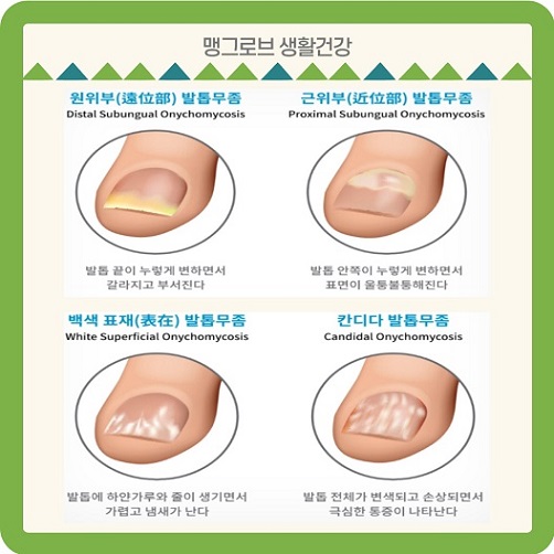 발톱무좀 종류