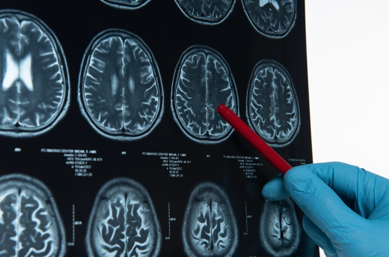 뇌출혈 초기 증상 (2025 건강 이슈)