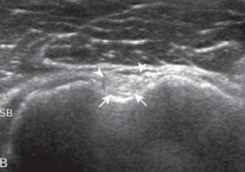두갈래근 긴힘줄 초음파 영상(short axis)