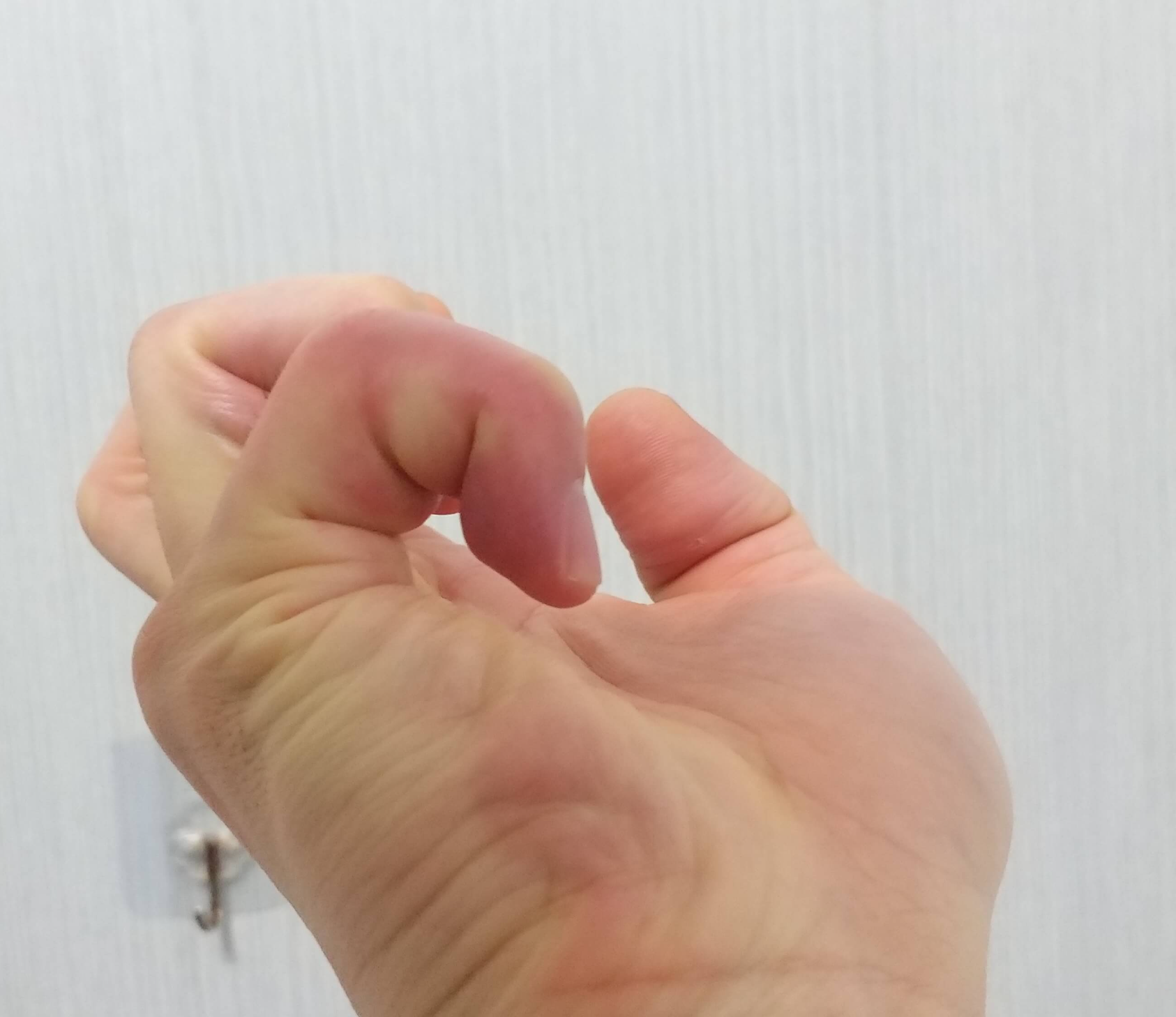 재활치료가잘되거의구부러짐