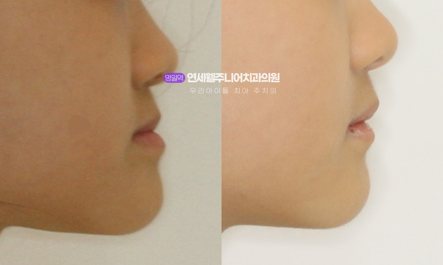 초등학생 주걱턱교정 전후 턱 성장 변화 측면 비교