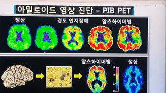 아밀로이드 축적 영상