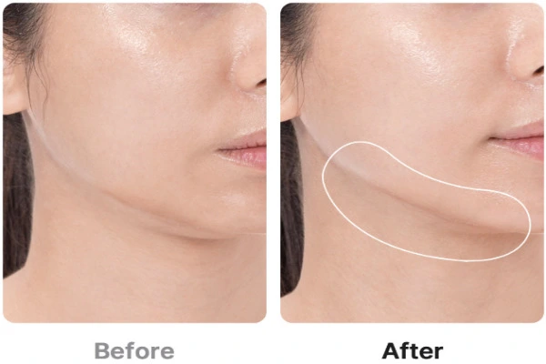 메디큐브 부스터프로