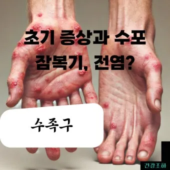 수족구 어른 전염에 대한 원인과 예방법 정리_17