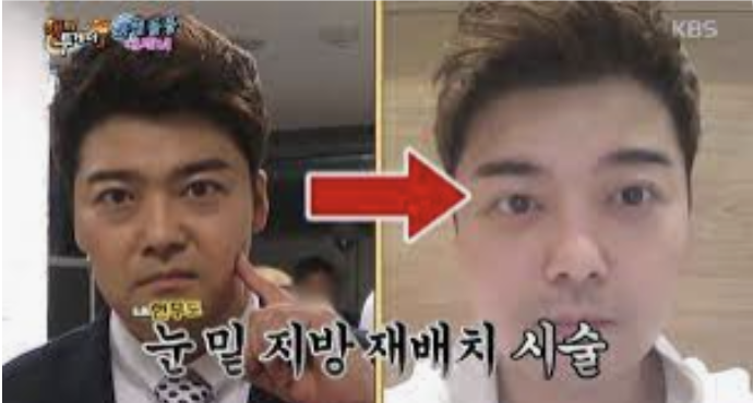 눈밑지방재배치 잘하는 곳