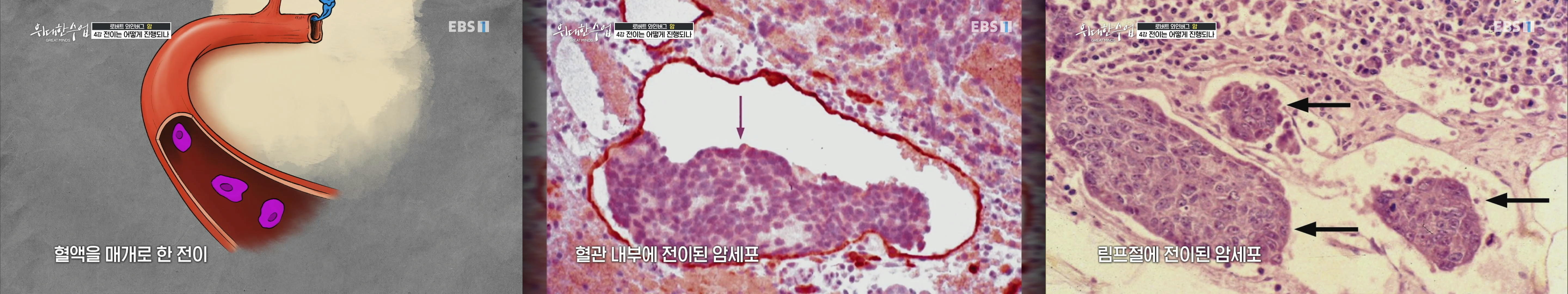 순환계에서의 암