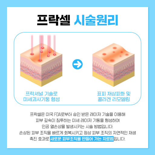 프락셀 원리