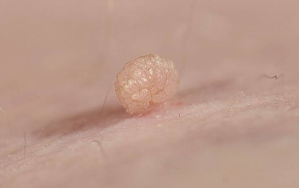 목에 있는 쥐젖의 모습