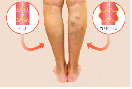 하지정맥류