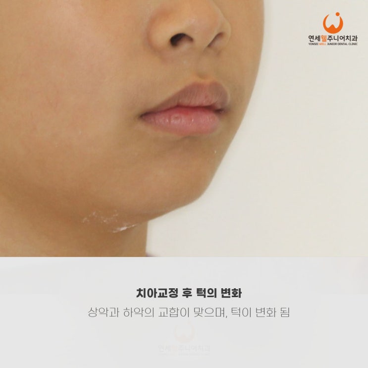 위아래 턱 관계가 조정된 측면 모습