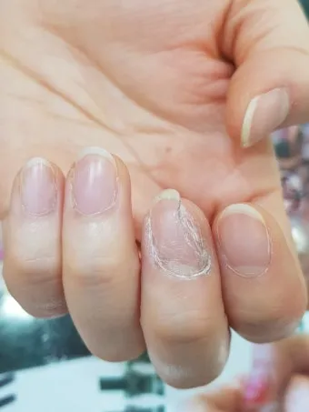 손톱이 갈라지는 이유 원인 증상 대처법_3