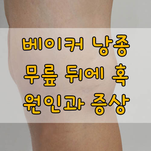 베이커 낭종&#44; 무릎 뒤에 혹이 생겼다? 원인과 증상