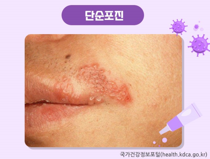 단순포진 이미지
