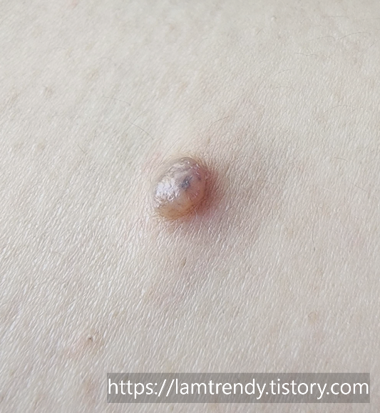 쥐젖 냉동치료 바로 직후