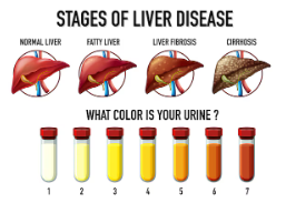 간수치 높을 때 증상
