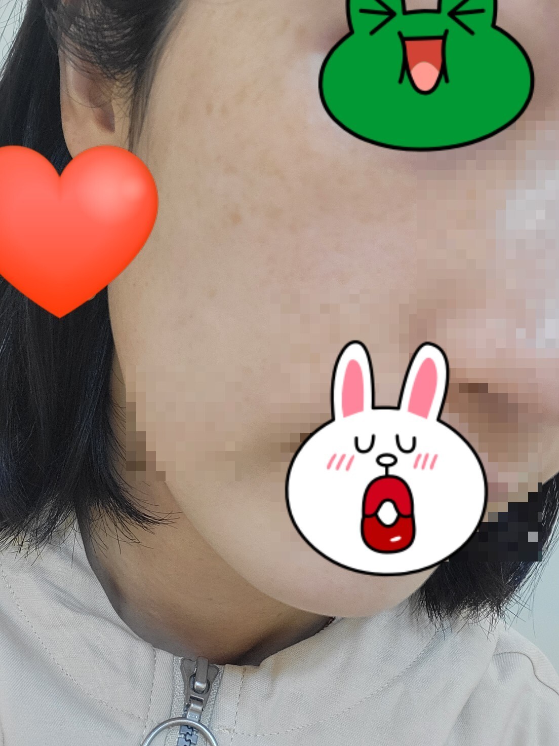 흑자레이저 후기