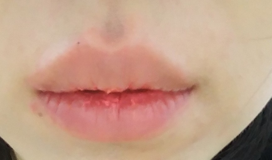 입술이 붓는 이유