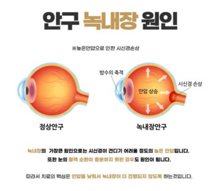 녹내장 원인