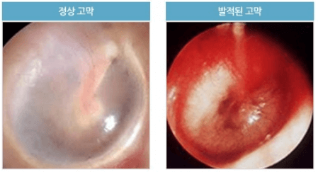 중이염 원인과 치료