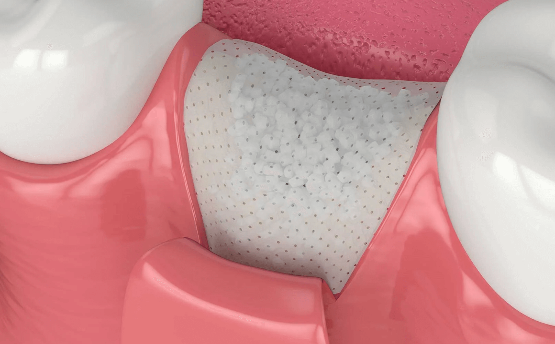 잇몸 뼈이식 통증