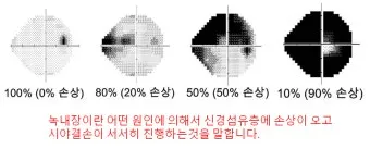 녹내장 진단 검사 비용 안압 검사주기 관리법_15