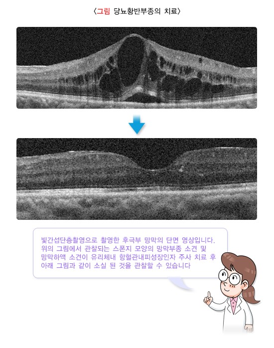 당뇨망막병증