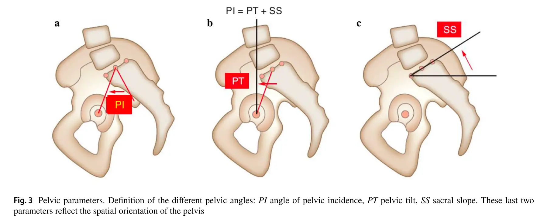 척추의 시상면 균형(Sagittal Balance of the Spine): 임상적 중요성과 치료 전략