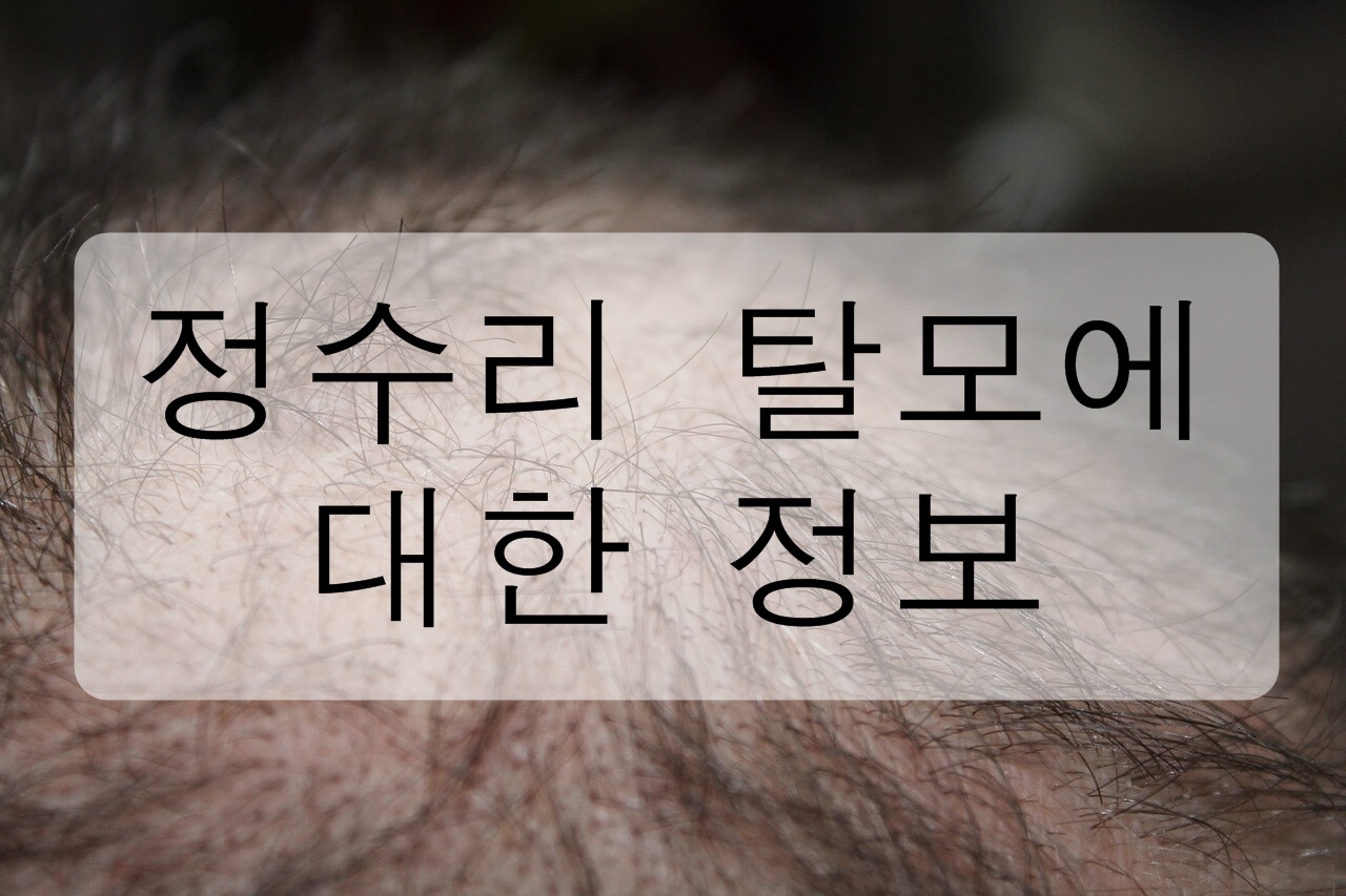 정수리 탈모에 대해 알아보자! (원인, 초기 증상, 예방, 치료 방법)