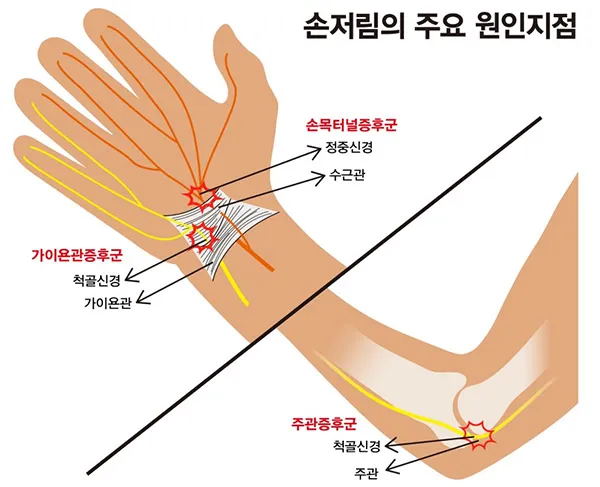 왼쪽 손이 저린 이유 완벽 건강 진단_3