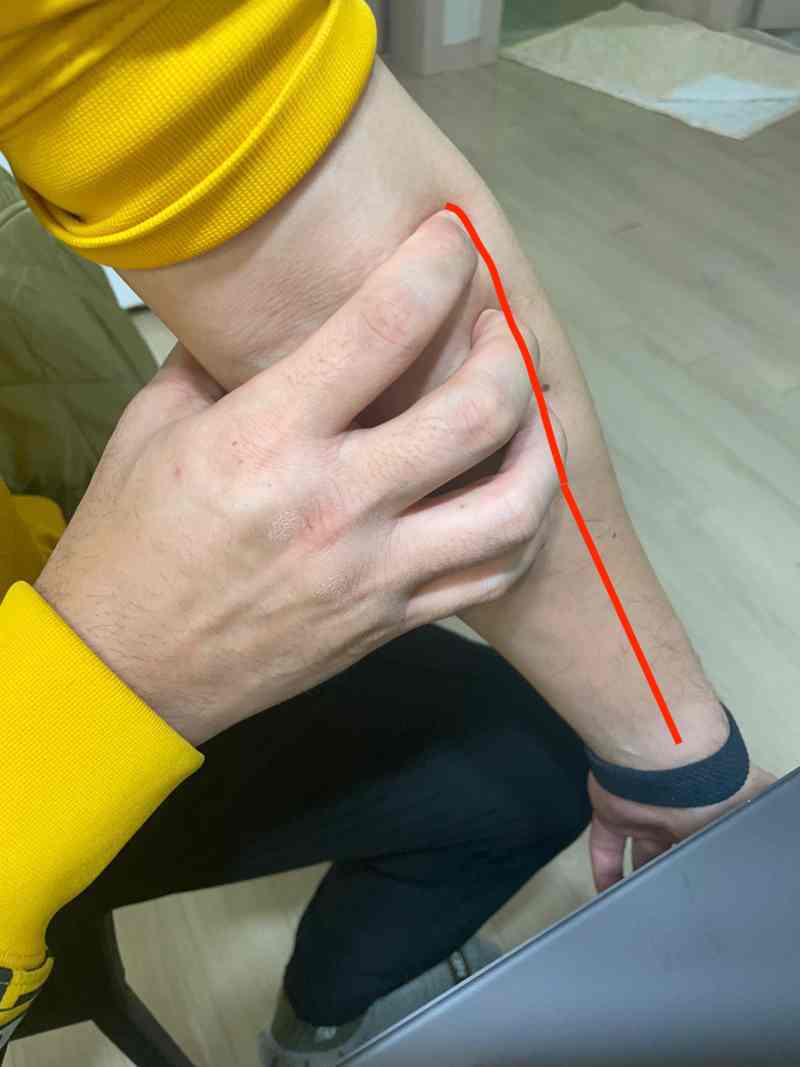 테니스엘보의 원인이 되는 근육위치