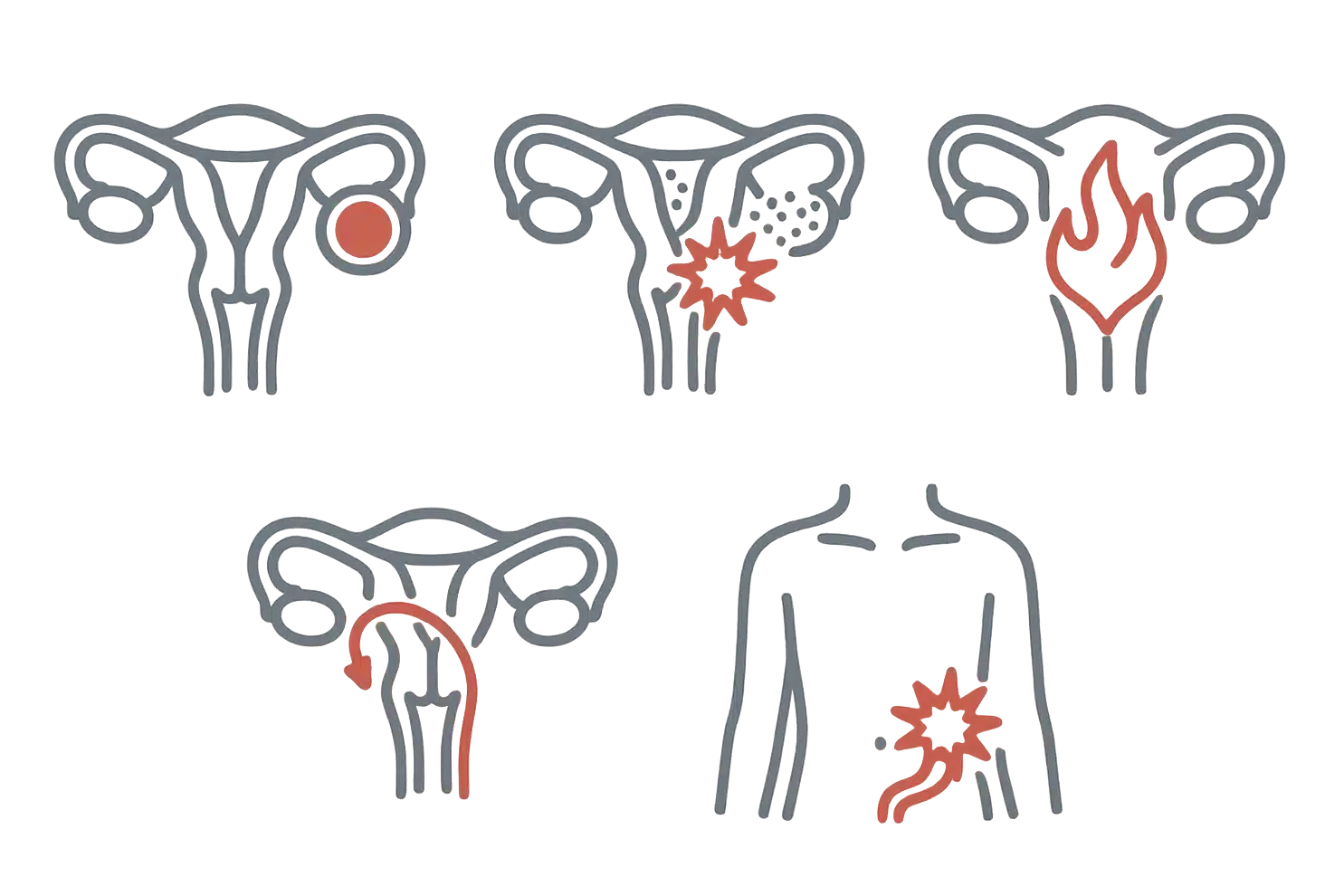 난소낭종, 자궁내막증, 골반염, 자궁 외 임신, 충수염
