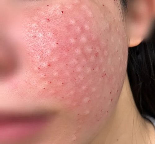 리쥬란 힐러 주사 시술 직후 볼 피부에 나타난 촘촘한 엠보싱 자국과 붉은 바늘 자국 현상 후기 사진