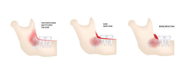 사랑니 발치 후 식사, 드라이 소켓이 생기는 이유에 대해 알아봤습니다. 사랑니 위치와 발치를 한 후에 조심해야 할 사항들, 사랑니를 발치하지 않으면 생기는 질병까지 꼼꼼히 읽어 보시기 바랍니다.