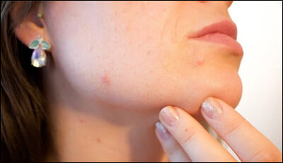 피부 트러블이 생긴 여성의 옆모습