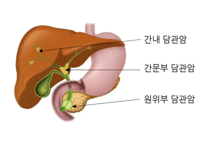 담관암-원인-위치